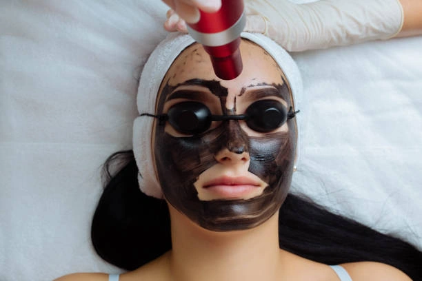 Carbon Peel