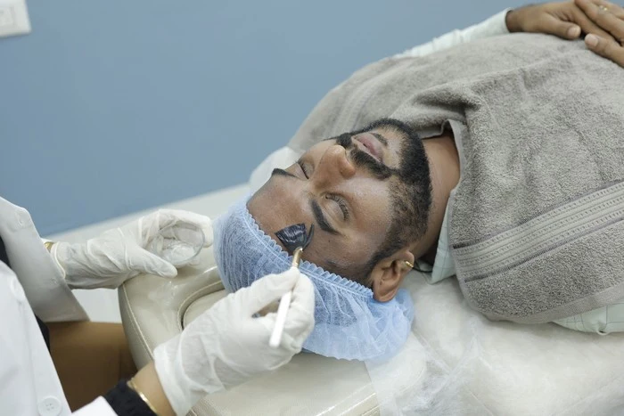 Chemical Peel Image 5
